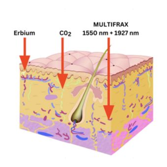 Multifrax - Digital Peel